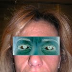 image liftingpre-vi-jpg